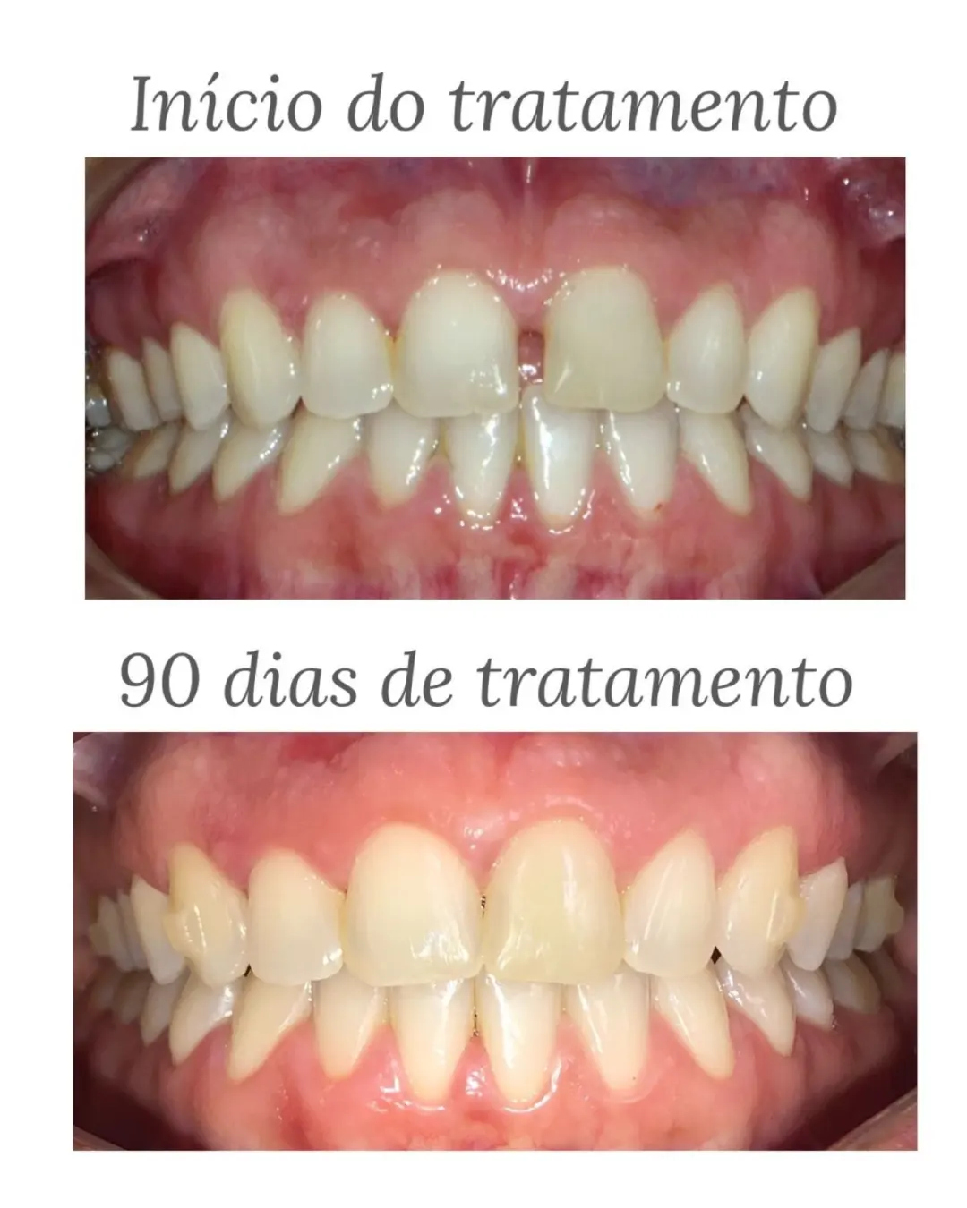 Antes e depois — evolução do tratamento ortodôntico em 90 dias